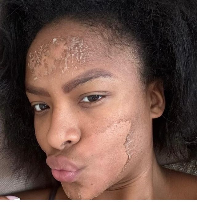 Skin Boosters Training