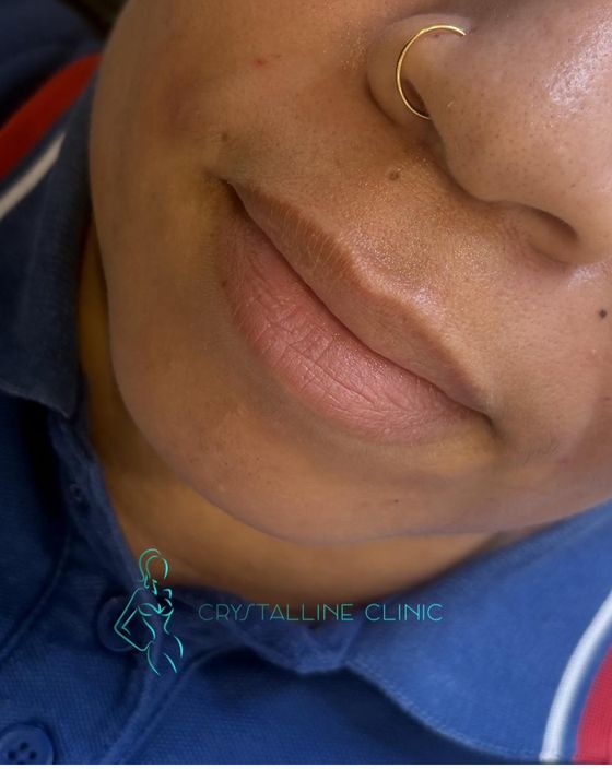 Dermal Fillers result