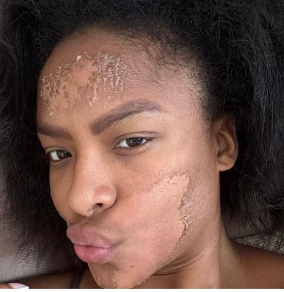 Facials result