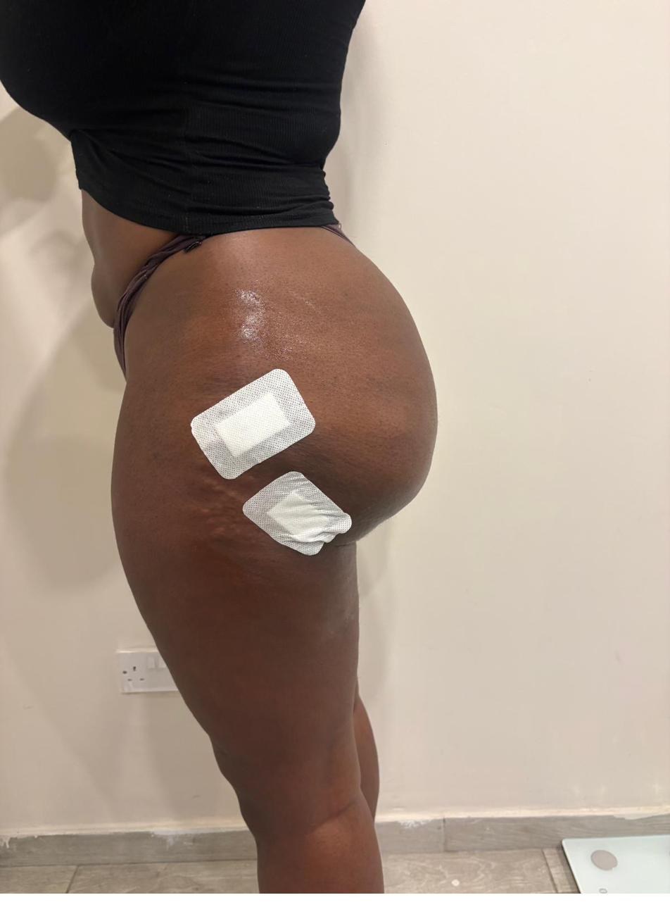 Liquid BBL result at Crystalline Clinic