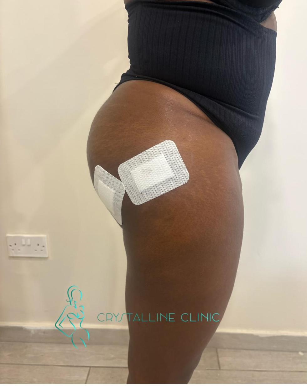 Liquid BBL result at Crystalline Clinic