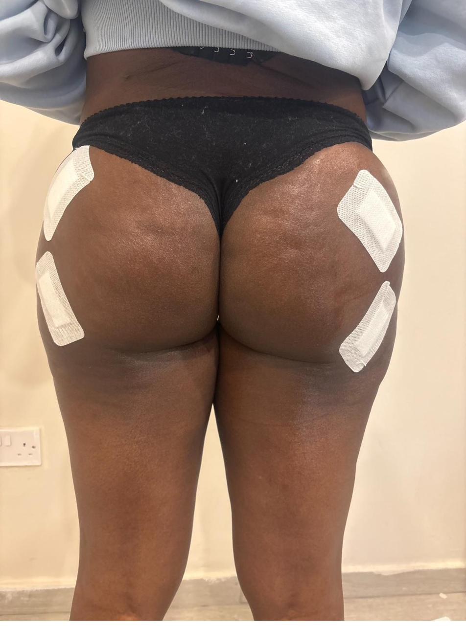 Liquid BBL result at Crystalline Clinic