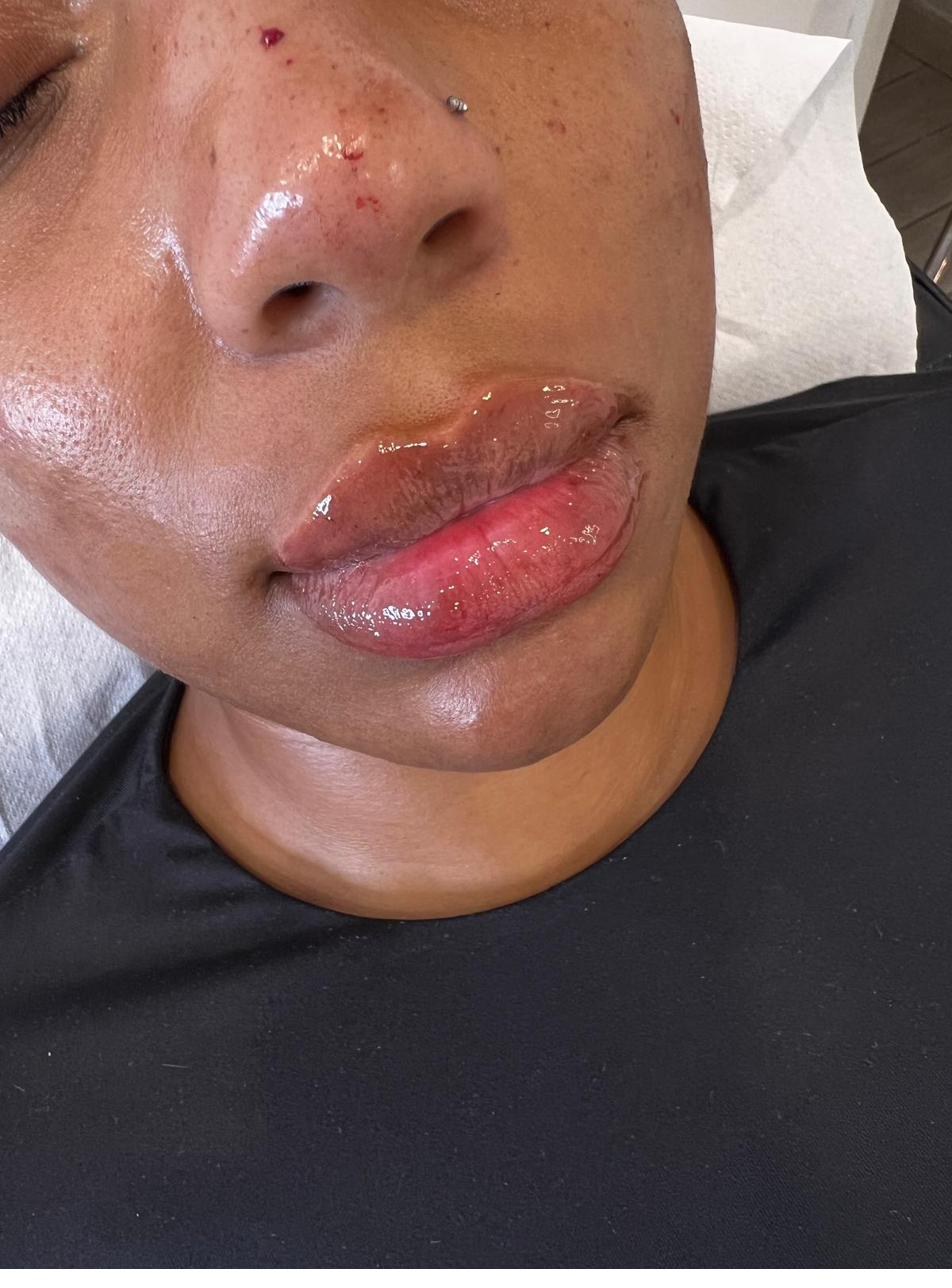 Lip filler result at Crystalline Clinic
